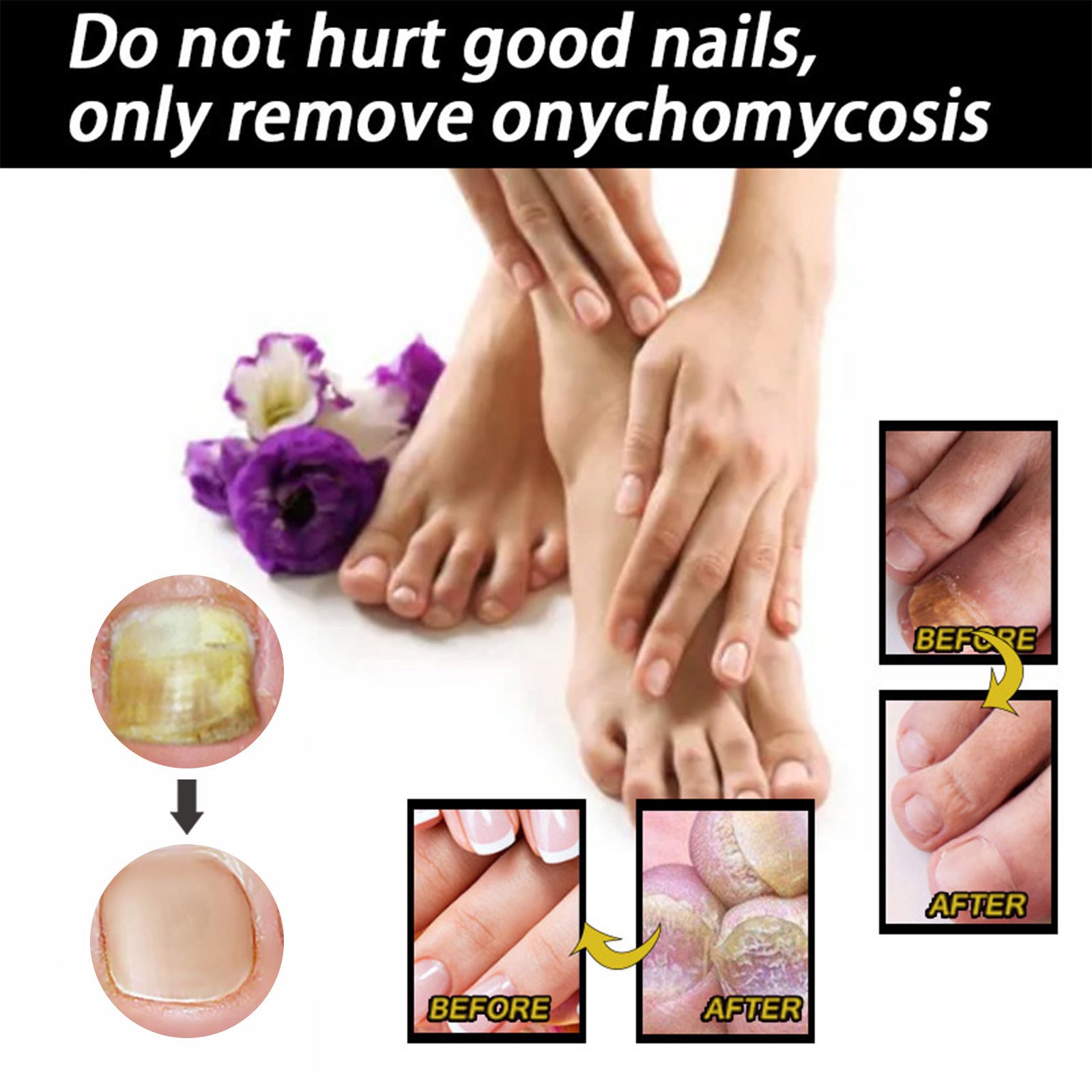Fungal Nail Treatment